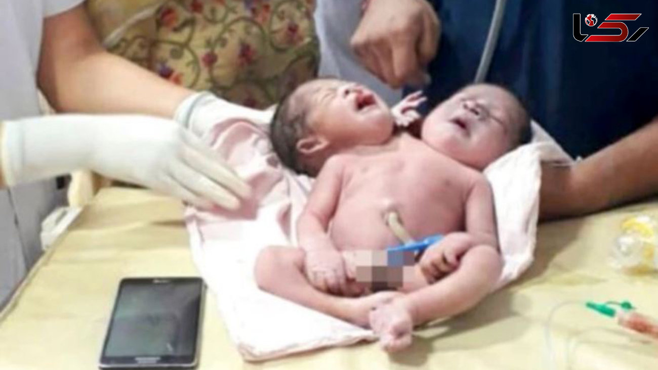 تولد نوزاد عجیب الخلقه در هند + عکس