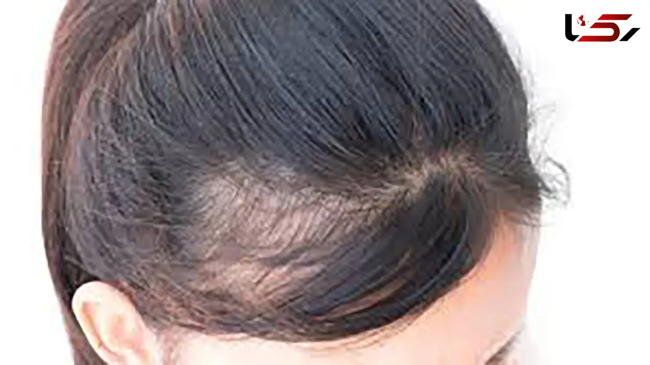 با طب سنتی به جنگ ریزش مو بروید