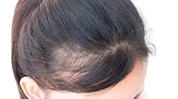 با طب سنتی به جنگ ریزش مو بروید