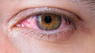 درمان های مفید قرمزی چشم 