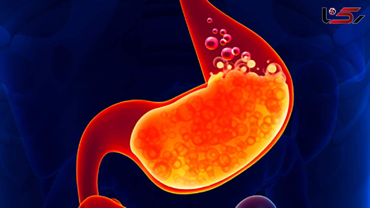  30 درصد مردم ایران مشکل ریفلاکس معده دارند / سرطان مری در کمین مبتلایان به ریفلاکس معده 