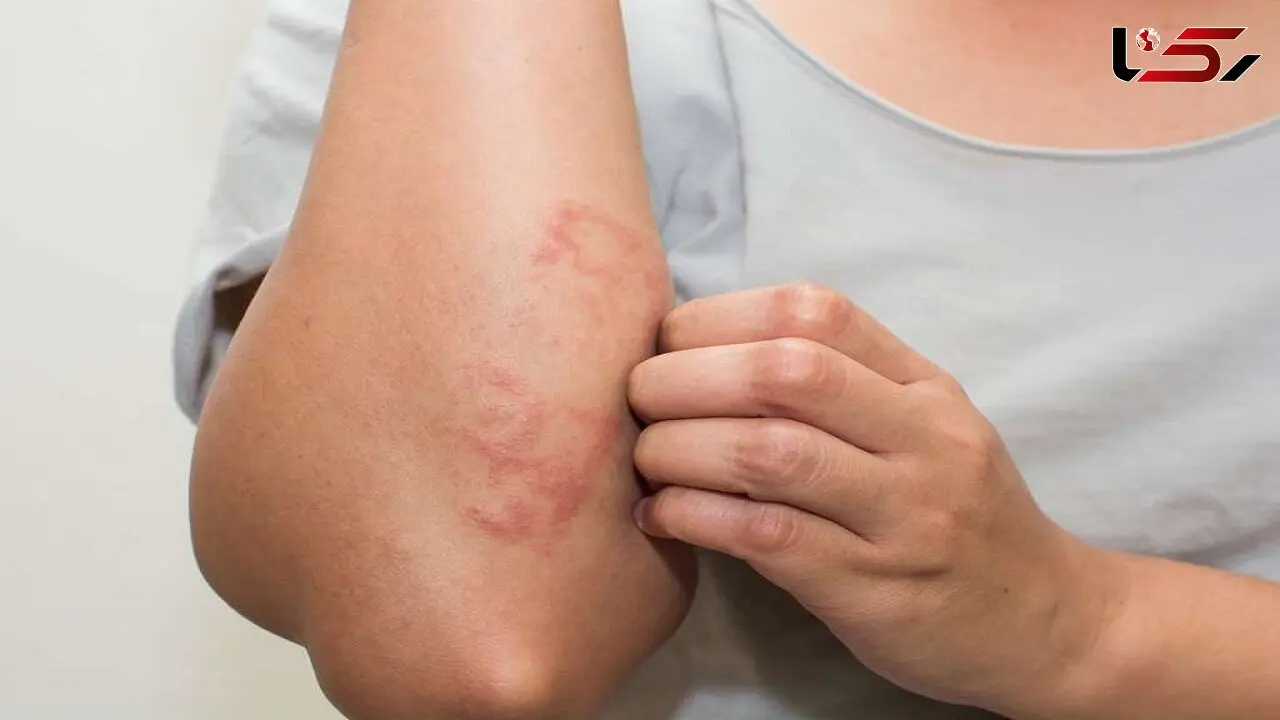 احتمال بروز ضایعه پوستی به عنوان تنها علامت ابتلا به کرونا
