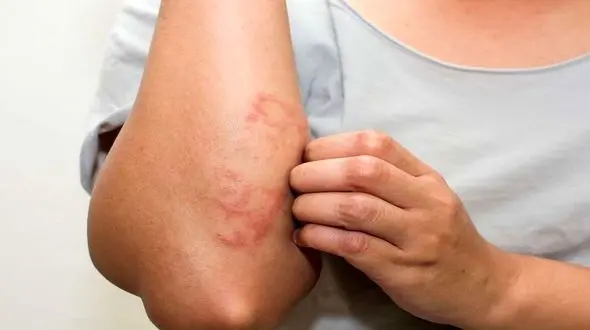 احتمال بروز ضایعه پوستی به عنوان تنها علامت ابتلا به کرونا