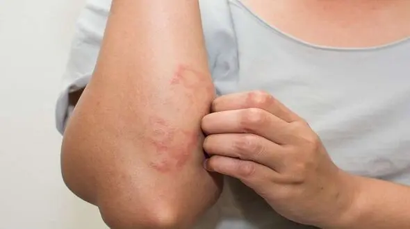 احتمال بروز ضایعه پوستی به عنوان تنها علامت ابتلا به کرونا
