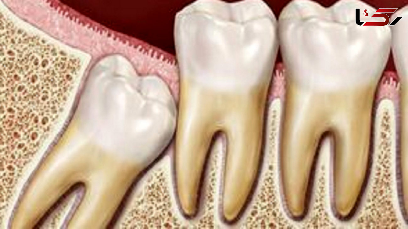 دلیل رشد دیرهنگام دندان عقل چیست؟