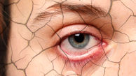 خشکی چشم چه نشانه هایی دارد؟ / درمان خشکی چشم و علت آن
