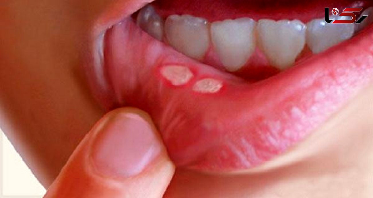 درمان سریع آفت دهان با روش‌های خانگی