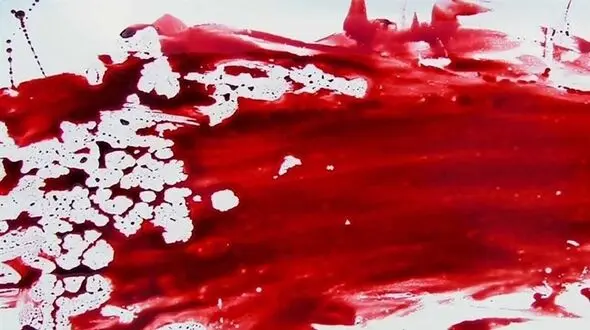 شکافتن قلب جوان 19 ساله با چاقو / جوان رودانی مرد و بعد زنده شد!