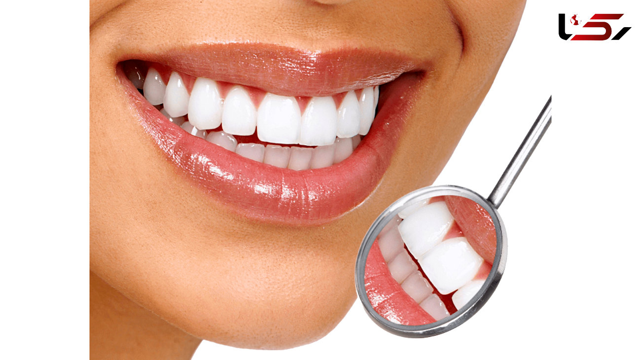 نکاتی در مورد سفید کردن دندان‌ها