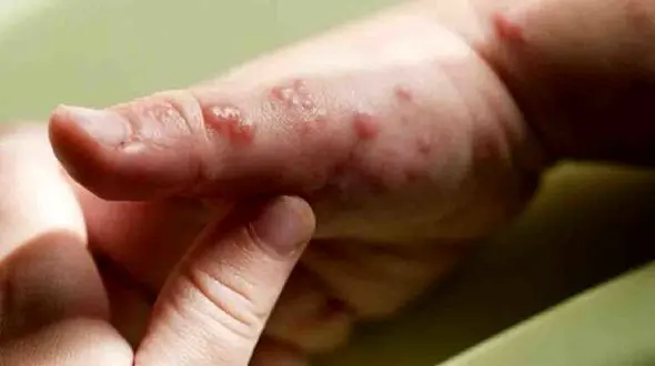 چطور جای آبله مرغان را محو کنیم؟