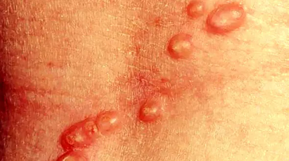   ابتلا 30 درصد از بزرگسالان ایرانی به جوش های ویروسی 