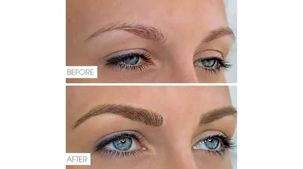 تفاوت میکروبلندیگ و میکروپیگمنتیشن 