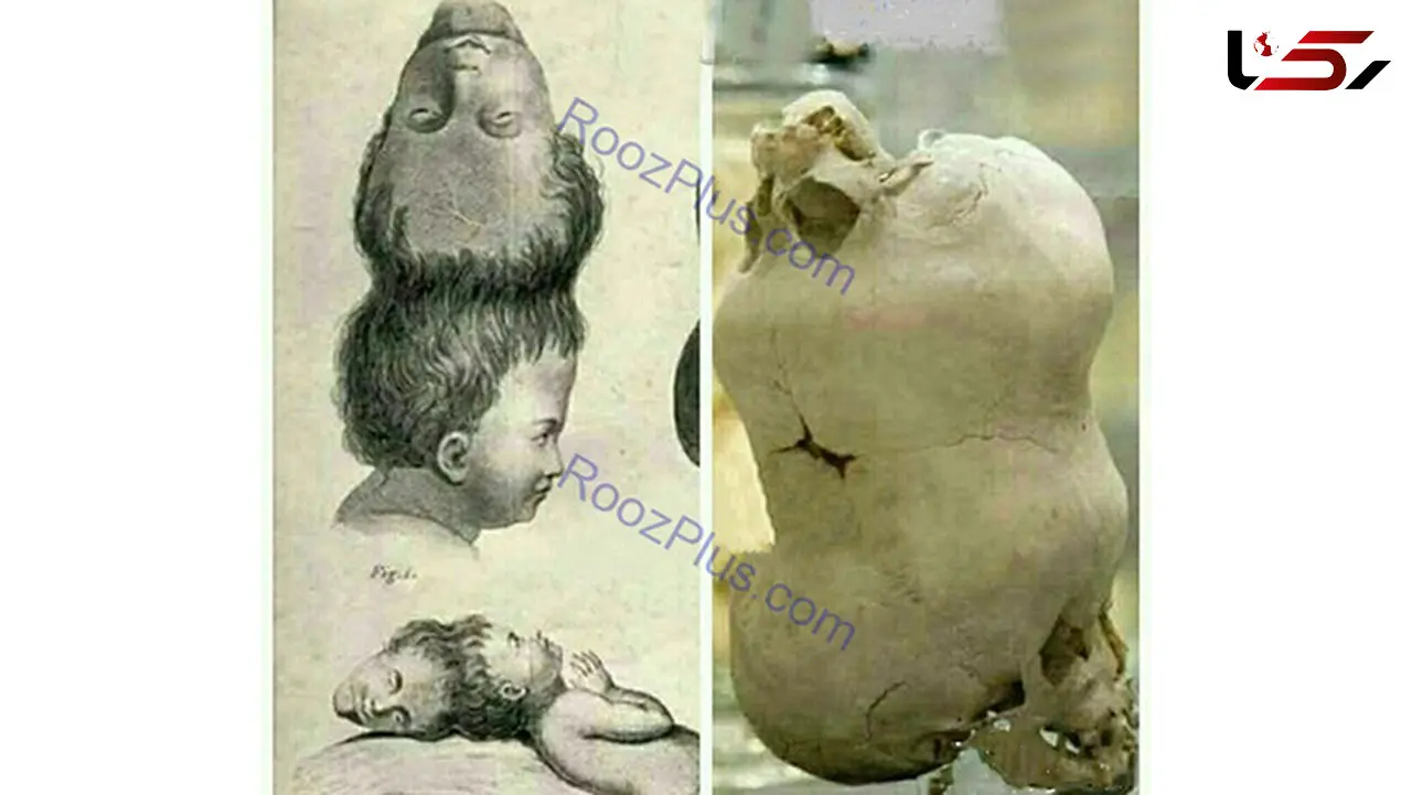 جمجمه پسر بچه ای با دو سر روی هم+عکس
