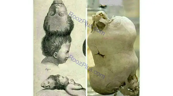جمجمه پسر بچه ای با دو سر روی هم+عکس
