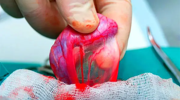 واریکوسل چیست؟  + جدول درمانی برای مردان