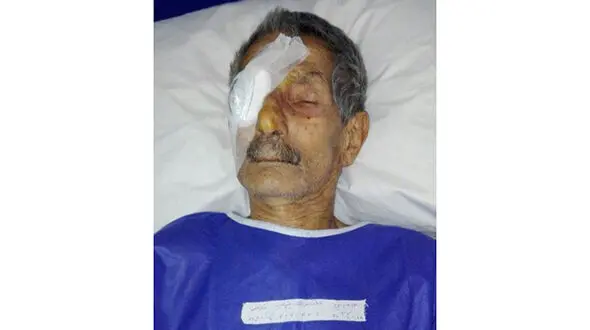 عمل جراحی چشم راست یک بیمار به جای چشم چپ او در نوشهرجنجال به پا کرد!+عکس