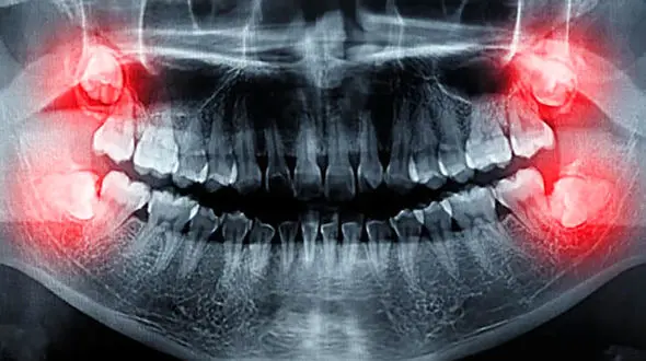 ریشه های بلند دندان عقل و درد طاقت فرسا / چه راهکار هایی برای پیشگیری و درمان وجود دارد؟