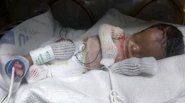 تولد نوزاد بدون پوست در تگزاس ! + عکس دلخراش 14+