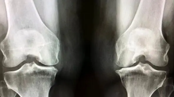 چگونه می‌ توان از آرتروز زانو در سالمندان پیشگیری کرد؟