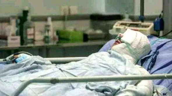  احتمال  کرونا در افراد دچار سوختگی بیشتر است.