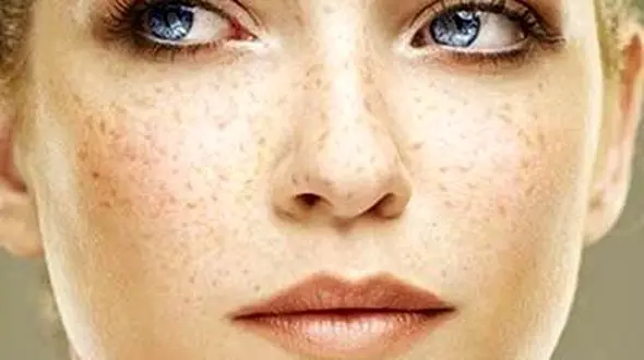 با پدیده کک و مک بیشتر آشنا شوید 