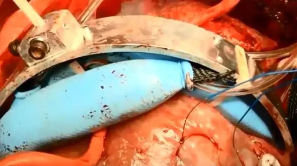 خونرسانی مناسب به قلب با ایمپلنت جدید 