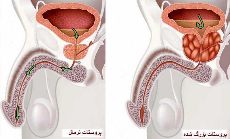 عکس از بزرگ شدن پروستات