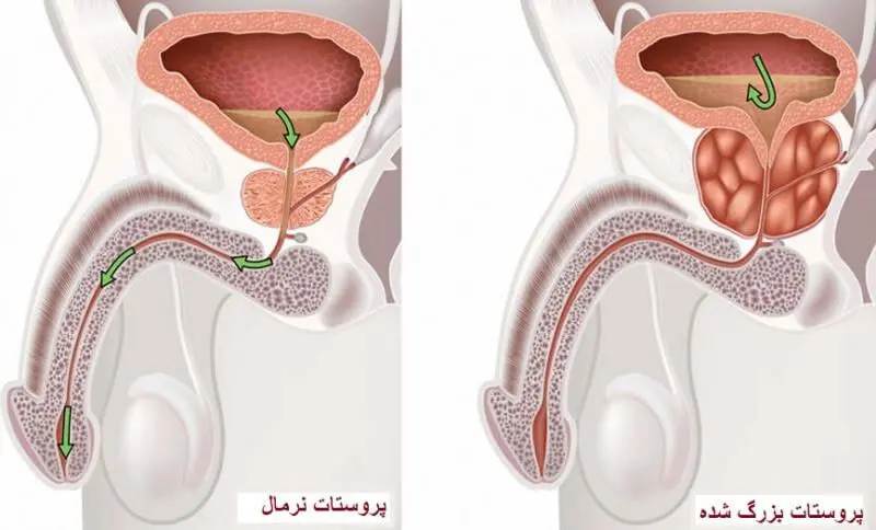 عکس از بزرگ شدن پروستات