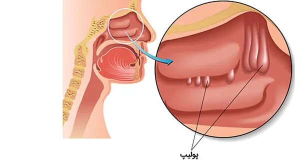 چرا در خواب دچار گرفتگی بینی می شویم؟
