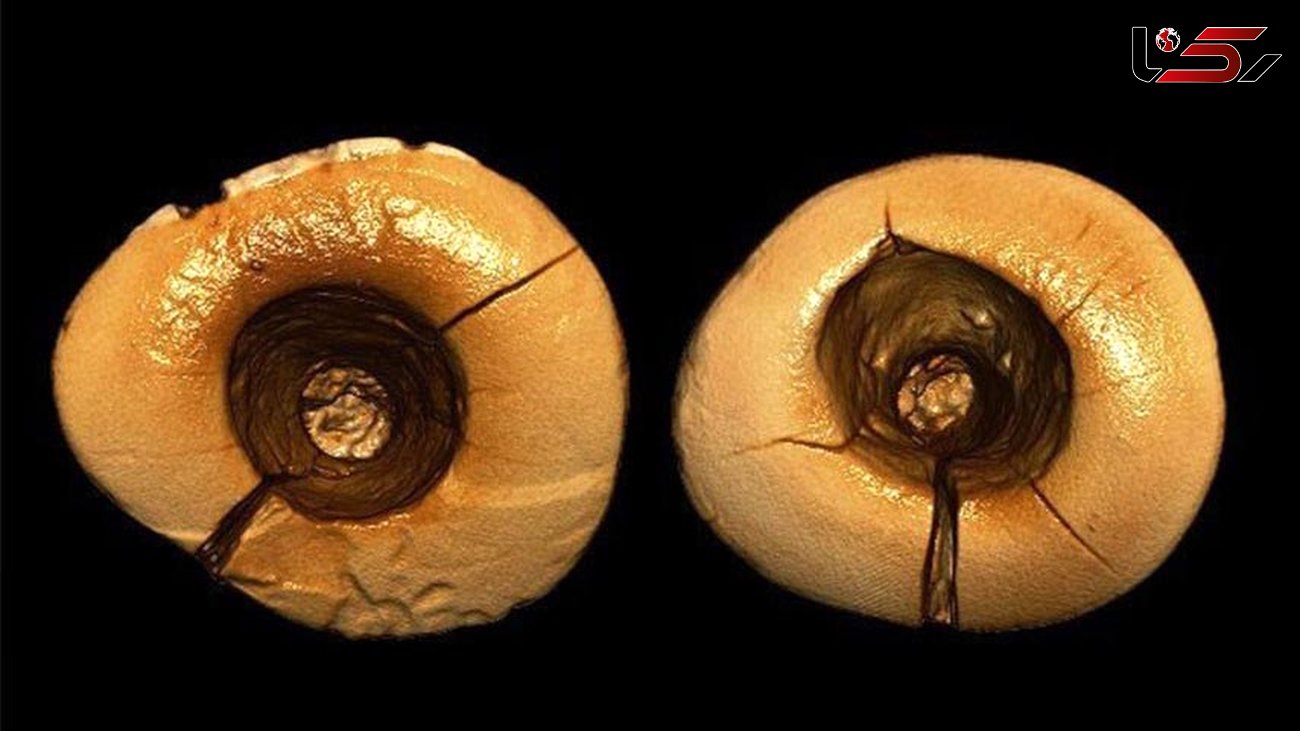  اولین دندان پر شده تاریخ کشف شد