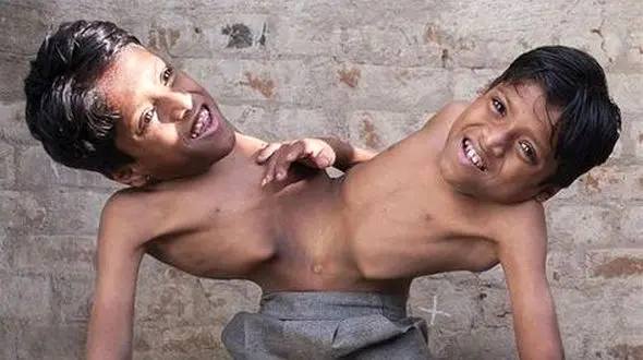 دوقلوهای به هم چسبیده هندی / پاهای مشترک از شکم دوش اخه ای + عکس 