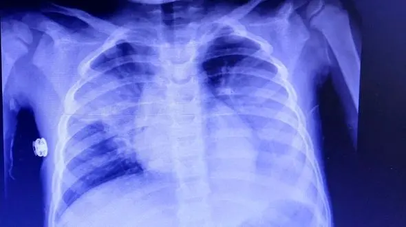 بازگشت ویروس‌های قدیمی خطرناک / مراقب کودکان باشید