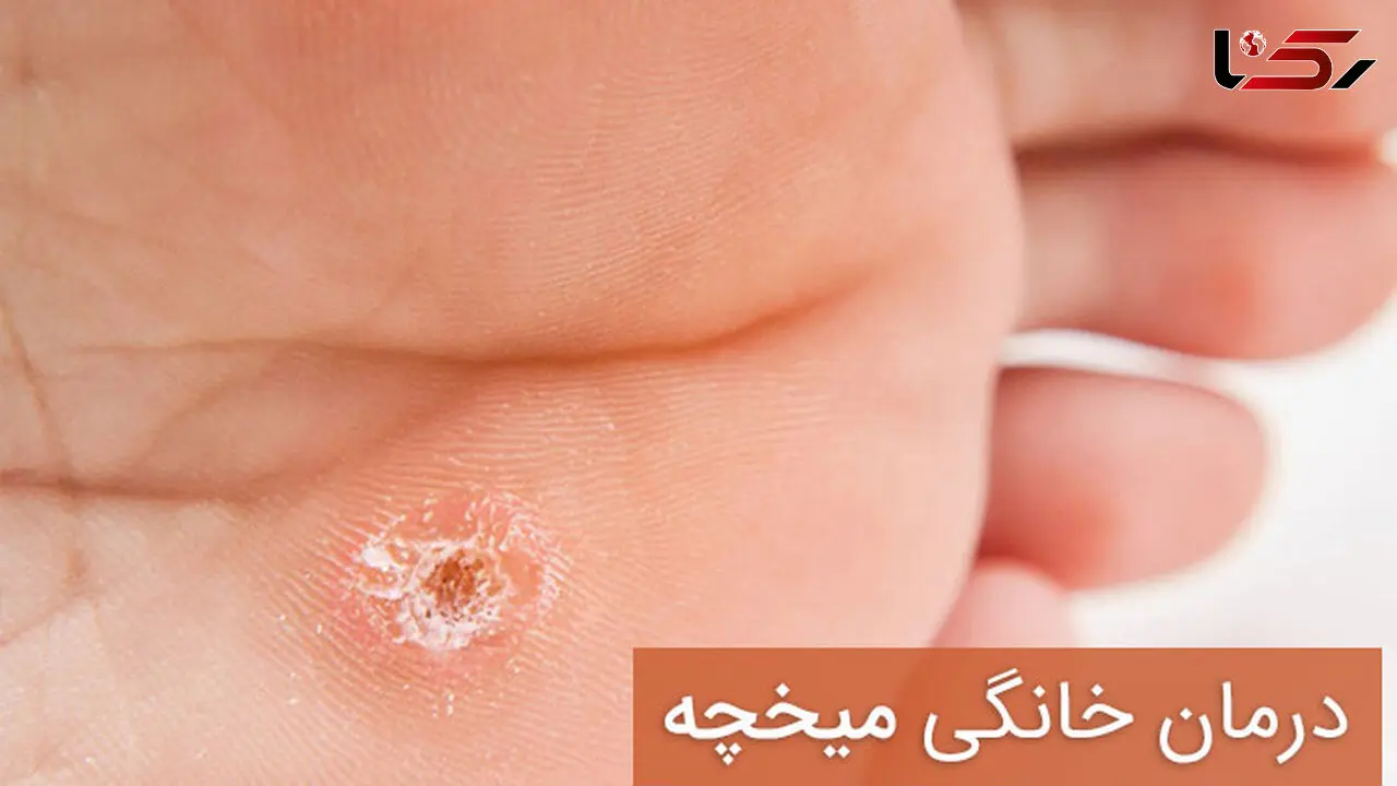 درمان خانگی میخچه / میخچه را جراحی نکنید