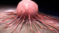 نرخ مرگ و میر در مردان مبتلا به سرطان سینه بیشتر است