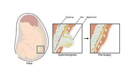 جراحی موفقیت آمیز ناهنجاری ستون فقرات یک جنین در هفته 26 بارداری