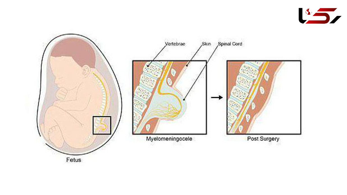 جراحی موفقیت آمیز ناهنجاری ستون فقرات یک جنین در هفته 26 بارداری