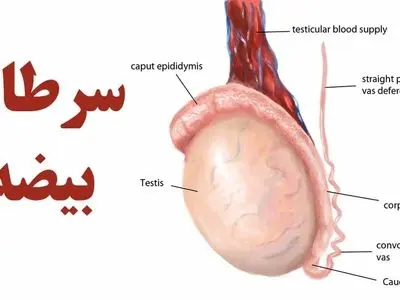آقایان بخوانند / 7 نشانه مهم سرطان بیضه