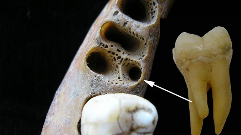 کشف دندان باستانی با سه ریشه +عکس 