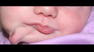 تولد نوزاد عجیب الخلقه با دو دهان + عکس