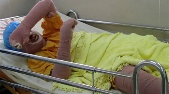 آخرین وضعیت علی نوجوان ایذه ای که دل به آتش زد / برایش دعا کنید + فیلم