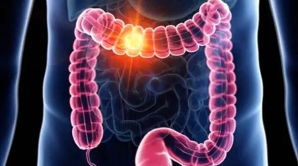 علائم گوارشی که نباید نادیده گرفته شوند؛ واقعاً هموروئید است؟