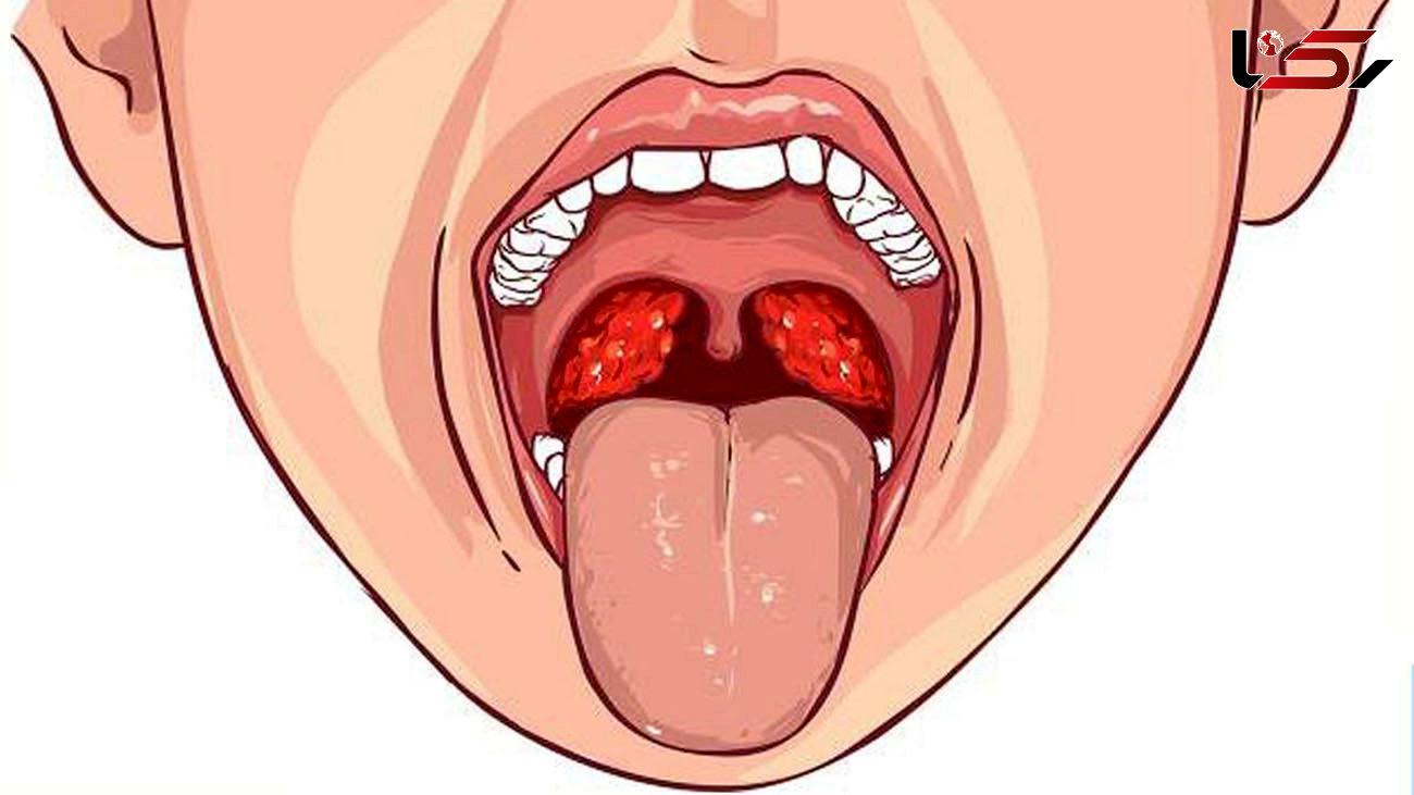 سرطان دهان چه نشانه‌هایی دارد؟