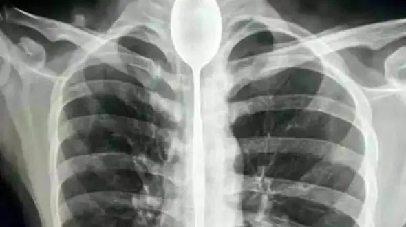 این مرد قاشق 20 سانتی را قورت داد تا شرط را ببرد+عکس