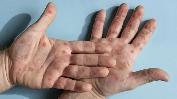 آبله میمون: همه آنچه باید بدانید