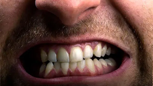 خطر استرس برای سلامت دندان‌هایتان را جدی بگیرید!