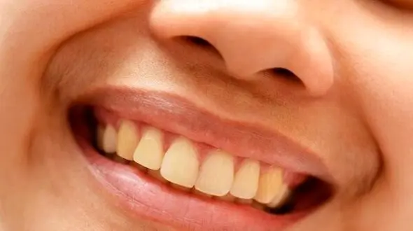 راز جلوگیری از دندان‌درد؛ عادت‌های سالم دندان‌پزشکی