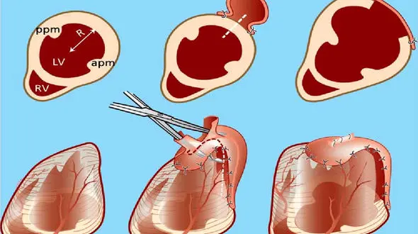 علائم بزرگ شدن قلب