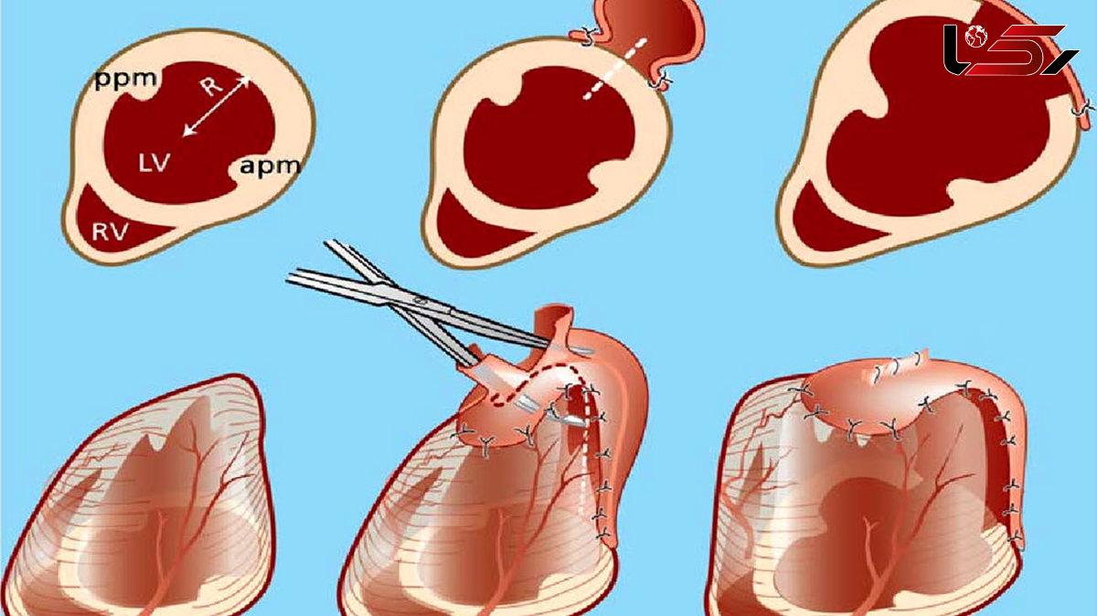 علائم بزرگ شدن قلب