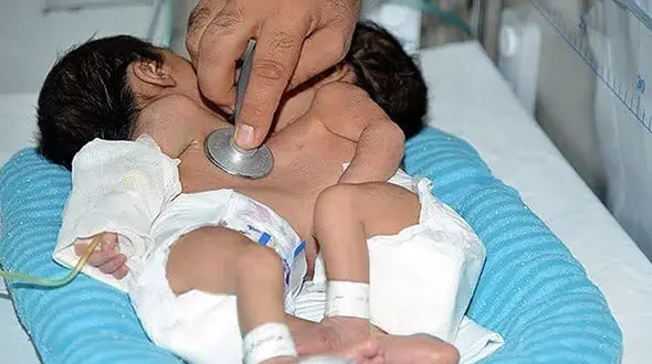 جداسازی خواهران دو قلو در بیمارستان نمازی شیراز + جزییات و فیلم