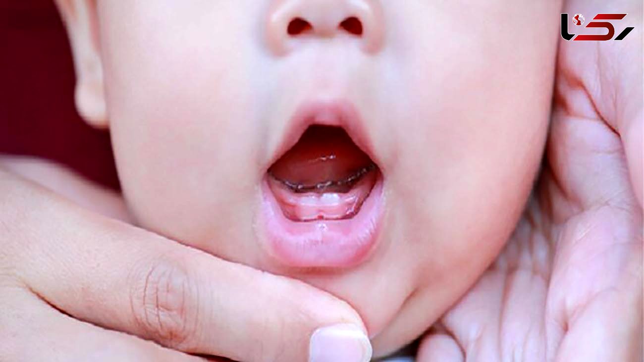 خطر پوسیدگی‌ دندان در پسربچه ها بیشتر است یا دخترها؟ 